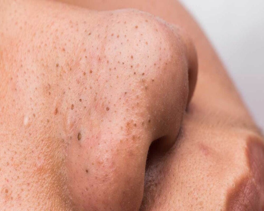 Mọi vùng da trên khuôn mặt đều phải chăm sóc cẩn thận